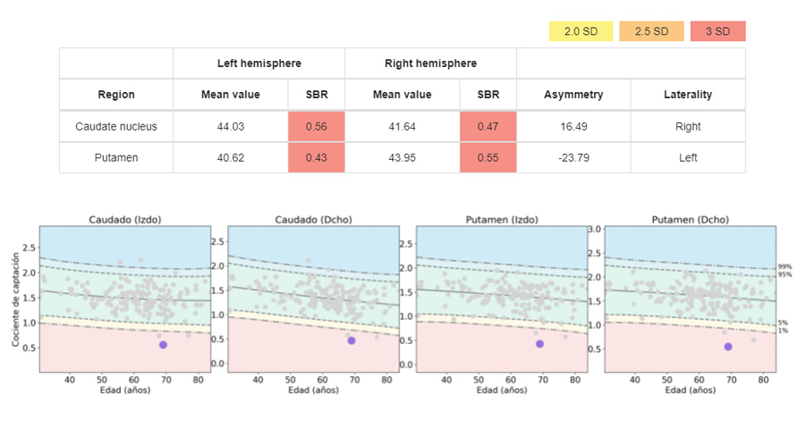 SPECT Ayuda en neurología Información visual y cuantitativa estructurada en un informe fácilmente configurable para una rápida interpretación de los resultados