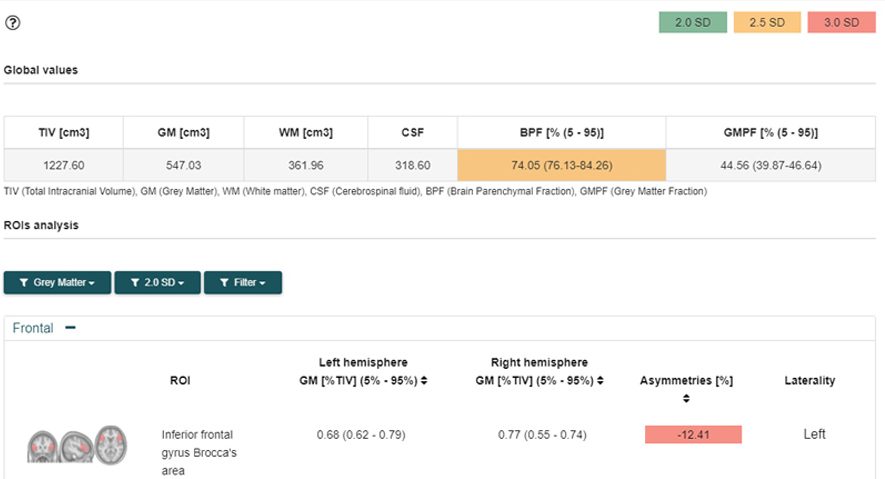VOL Ayuda en neurología La información cuantitativa te permite un tratamiento y seguimiento de la enfermedad objetivos y personalizados.