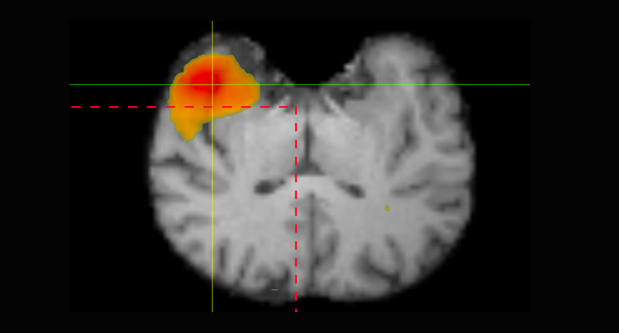 SISCOM Ayuda en epileptología Identifica el foco epileptogénico de forma rápida y precisa.