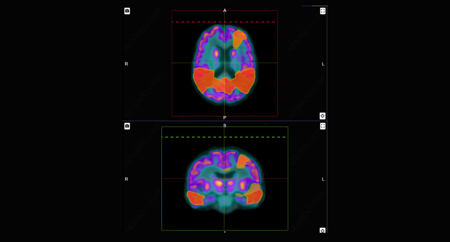PET Ayuda en medicina nuclear Proporciona de forma automática información visual